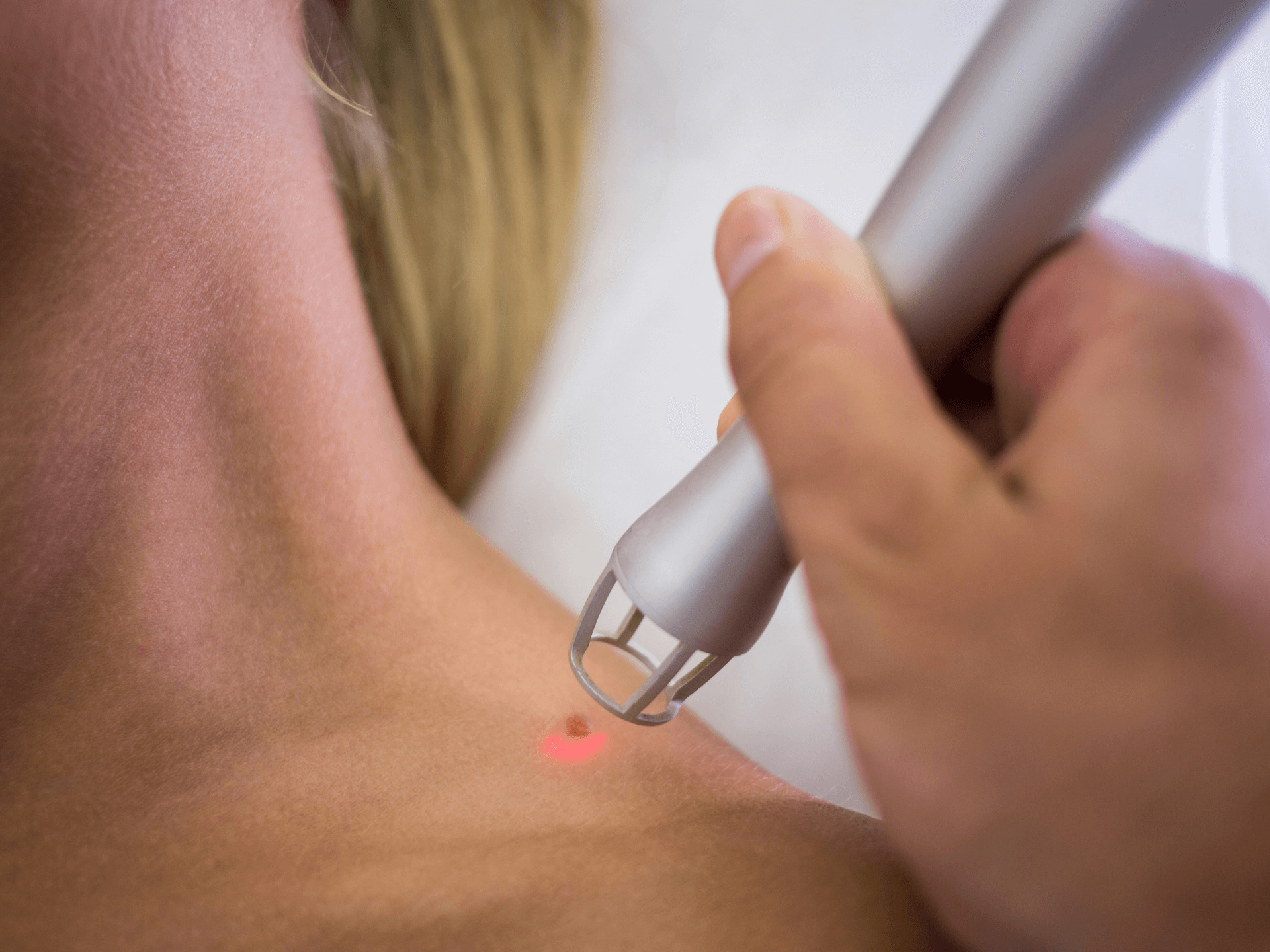 Laser Skin Tag Removal Portofino Clinic