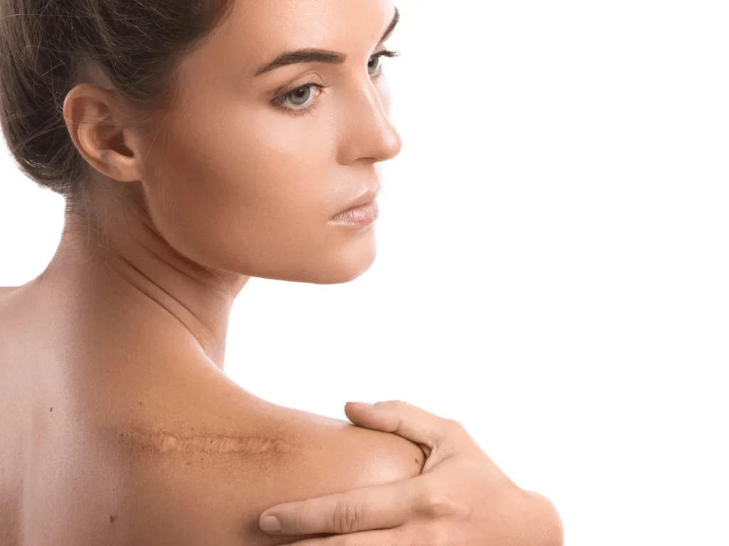 Post Surgical Scars Treatment