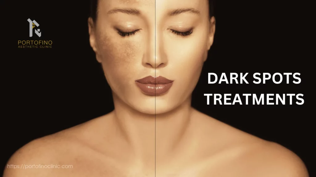 Dark Spots Treatments- Portofino Aesthetic Clinic