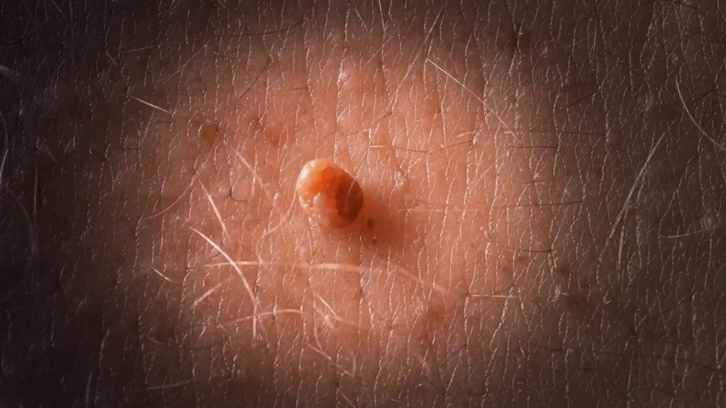 SKIN TAG REMOVAL TREATMENTS