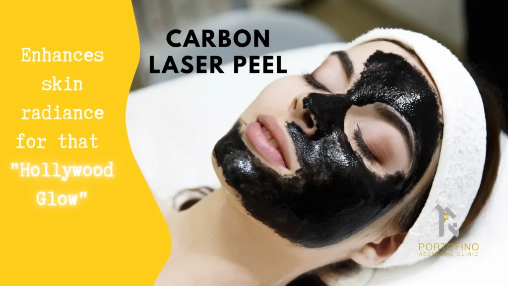 Carbon Peel Laser Treatment