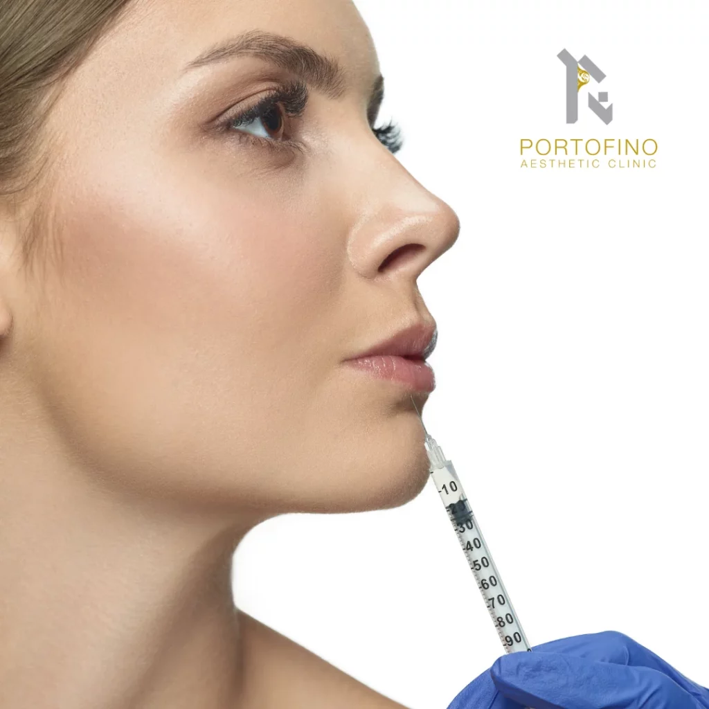Lip FIllers - Portofino Aesthetic Clinic