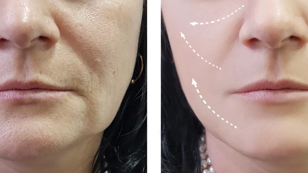 Fillers- Before and After