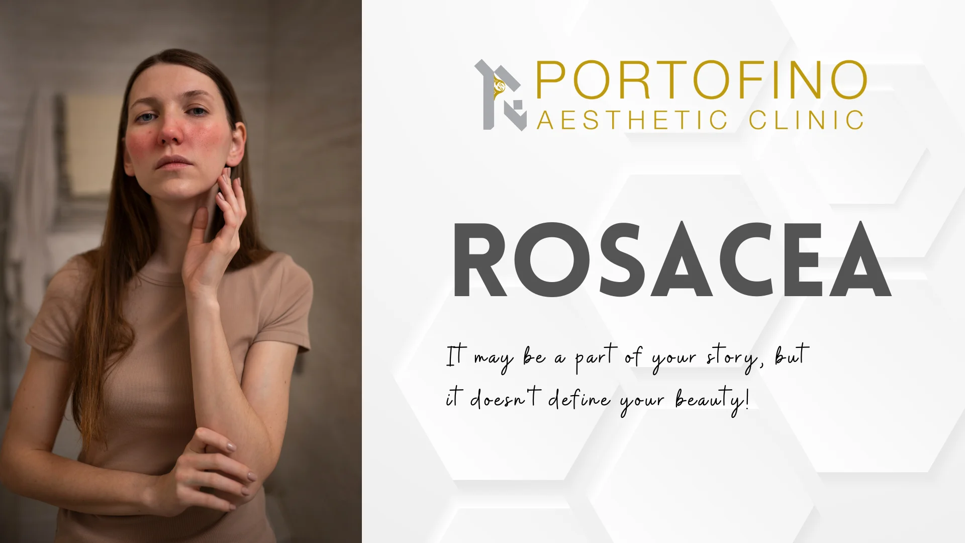 Rosacea Treatment- Best in Dubai