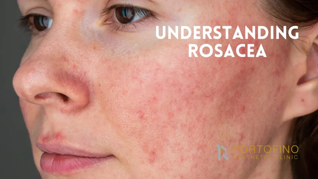 Understanding Rosacea - Portofino Clinic