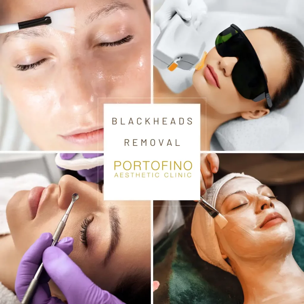 Best Blackheads Removal Treatments - Portofino Clinic