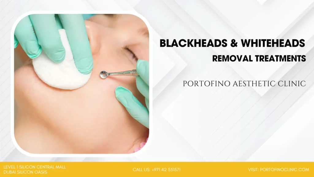 Blackheads Removal Treatments - Best in Dubai