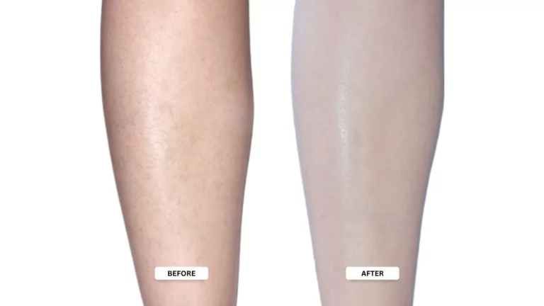 Full Body Laser Treatment - Before & After