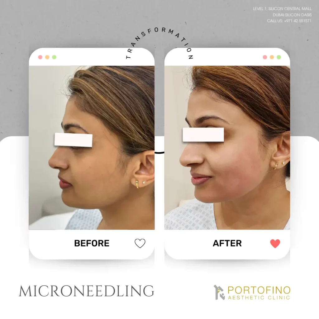 Before and After Photos Microneedling