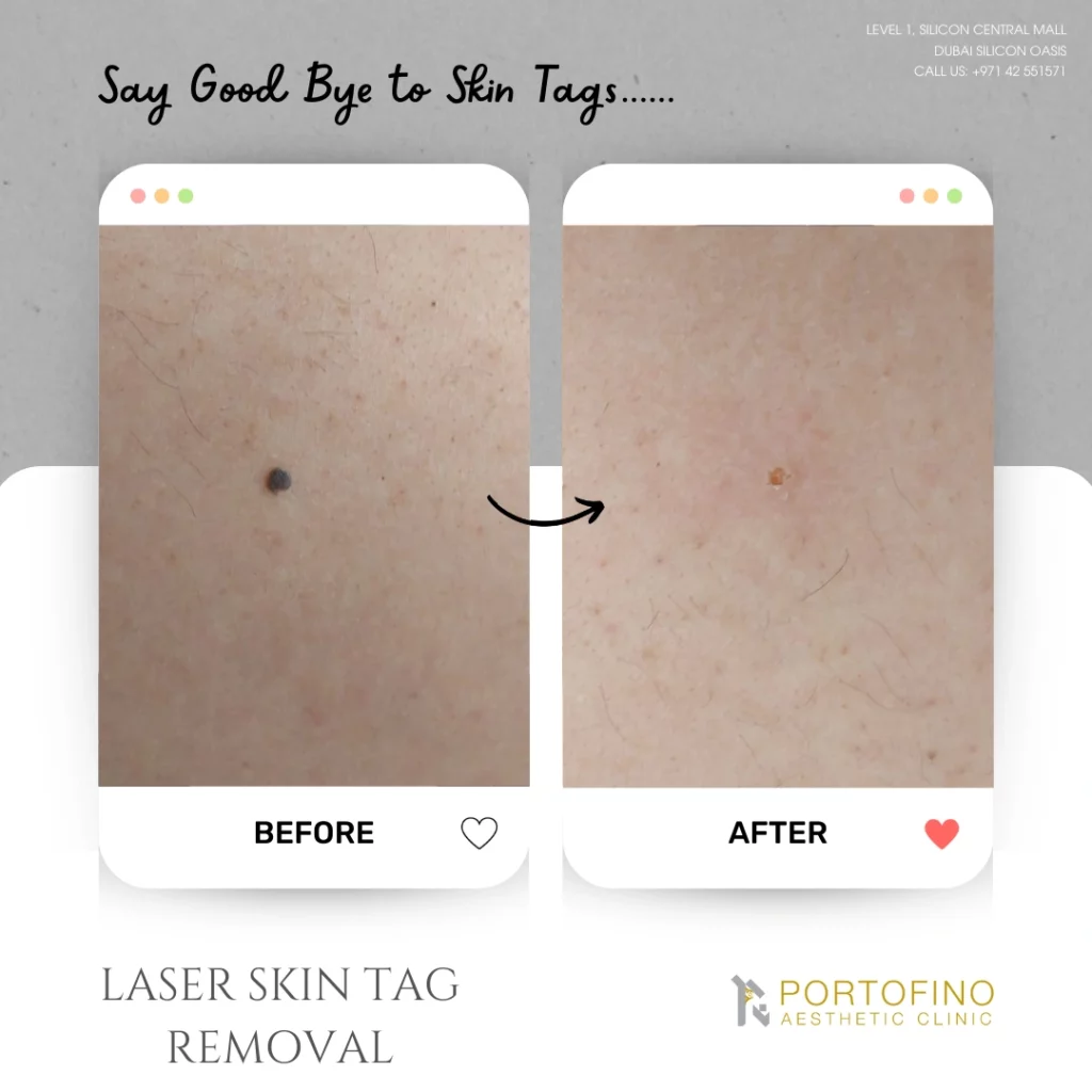 Laser Skin Tag Removal