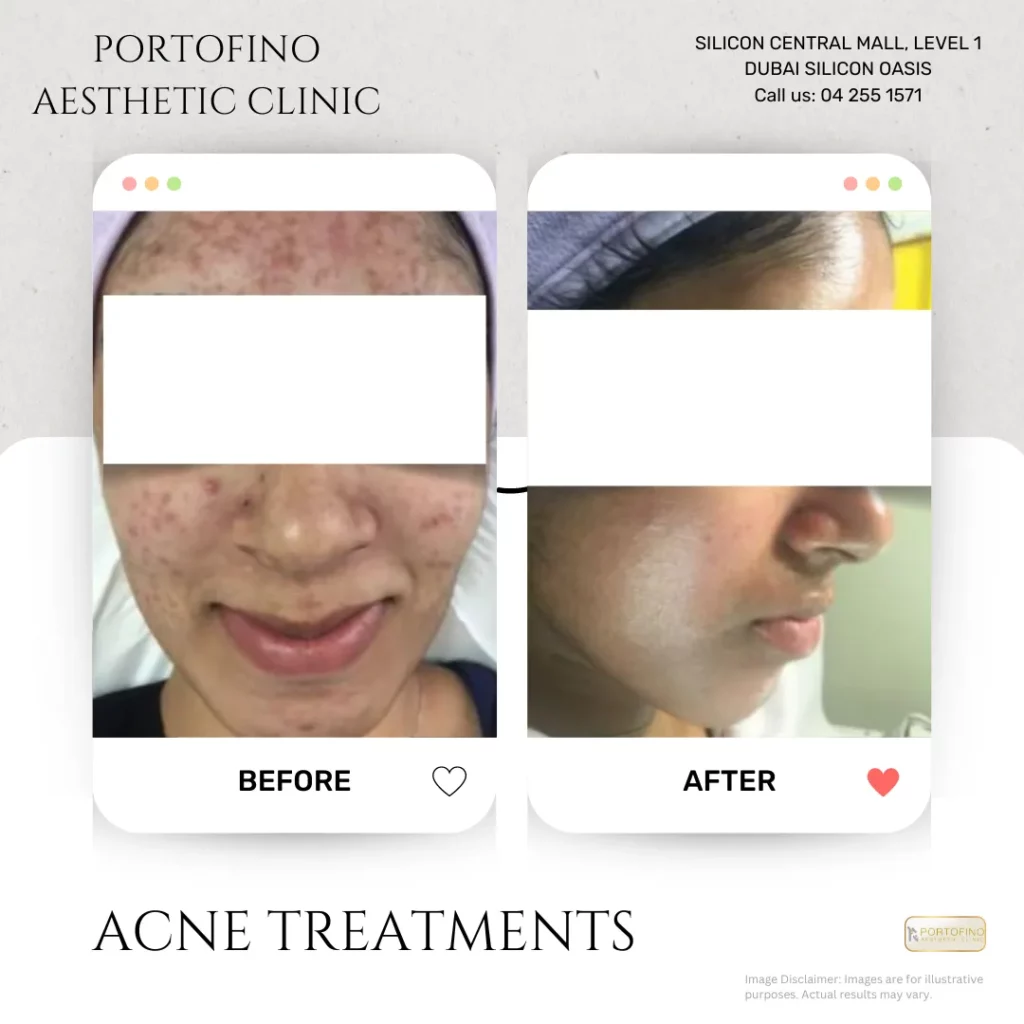 Acne Treatments - Before and After