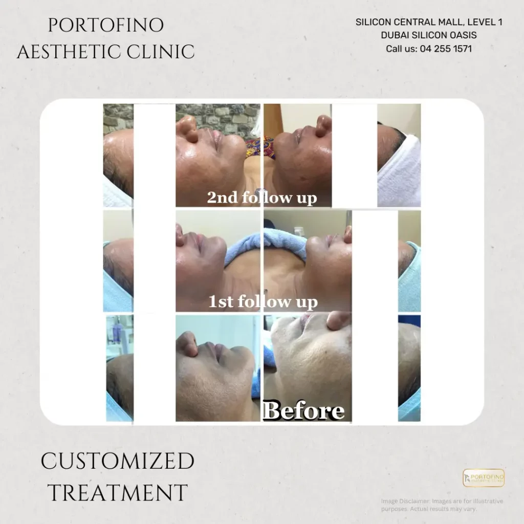 Custom Treatments - Before and After