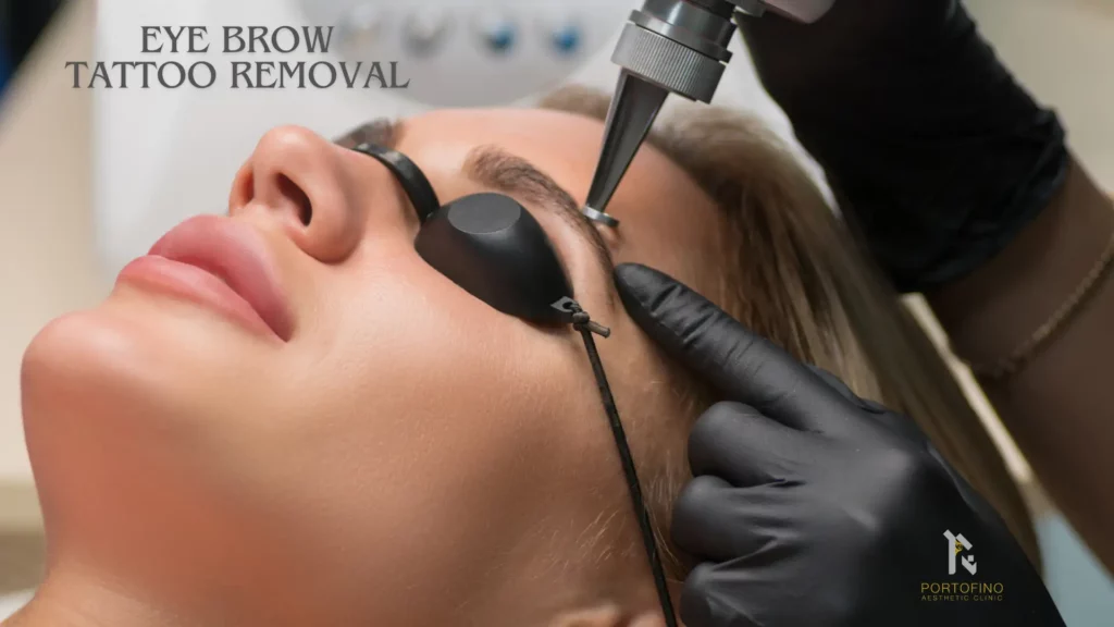 Laser Eye Brow Tattoo Removal