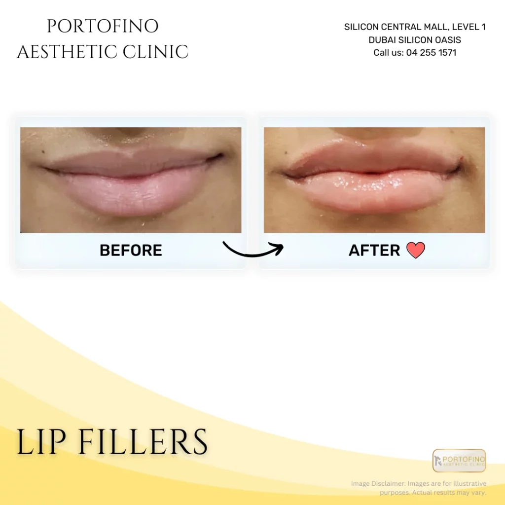 Lip Fillers - Before and After