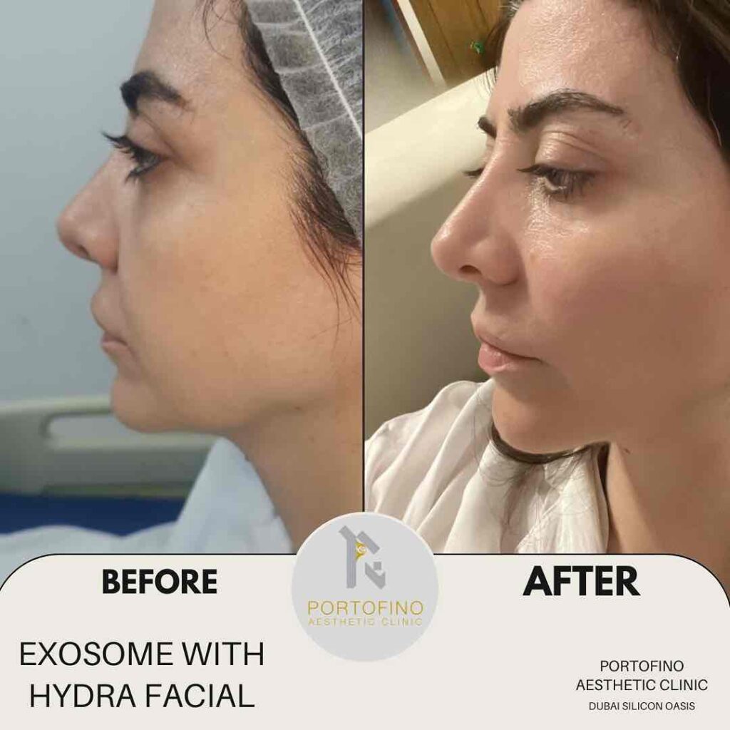 EXOSOME WITH HYDRA FACIAL