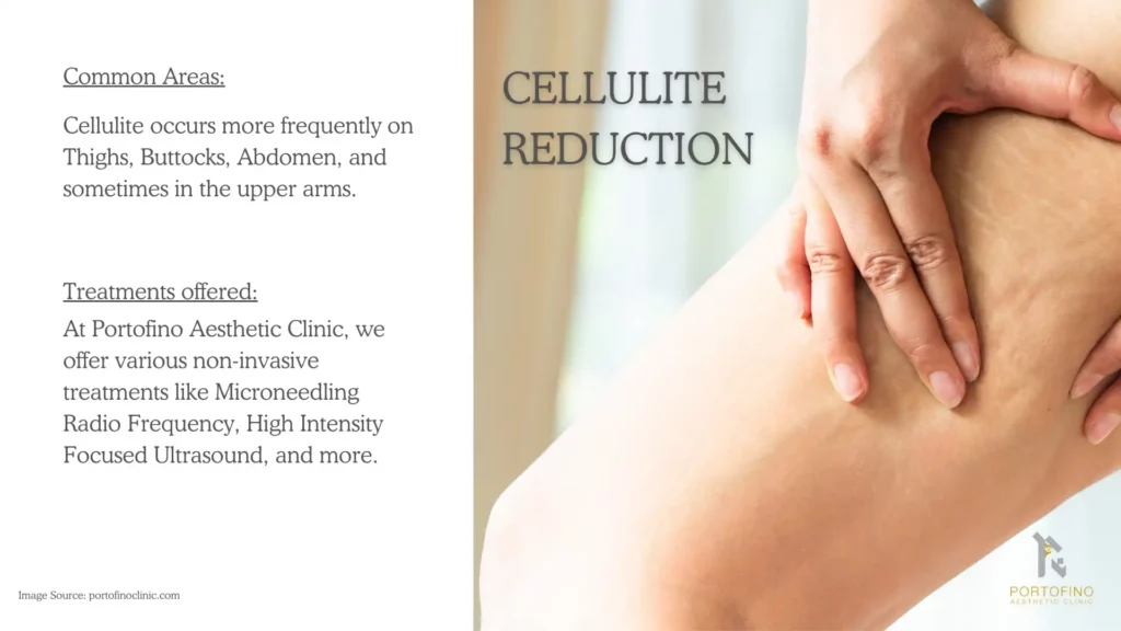 Cellulite Reduction Treatments