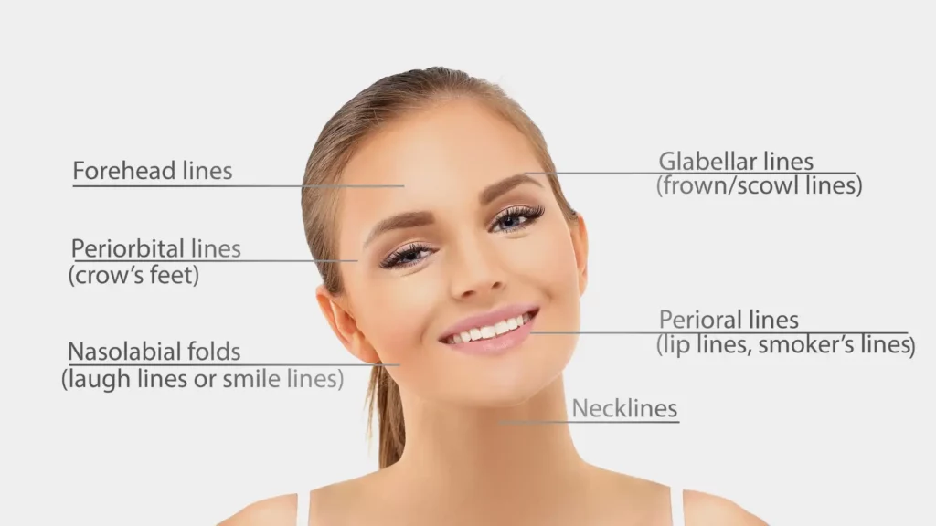 Dermal Filler Zones