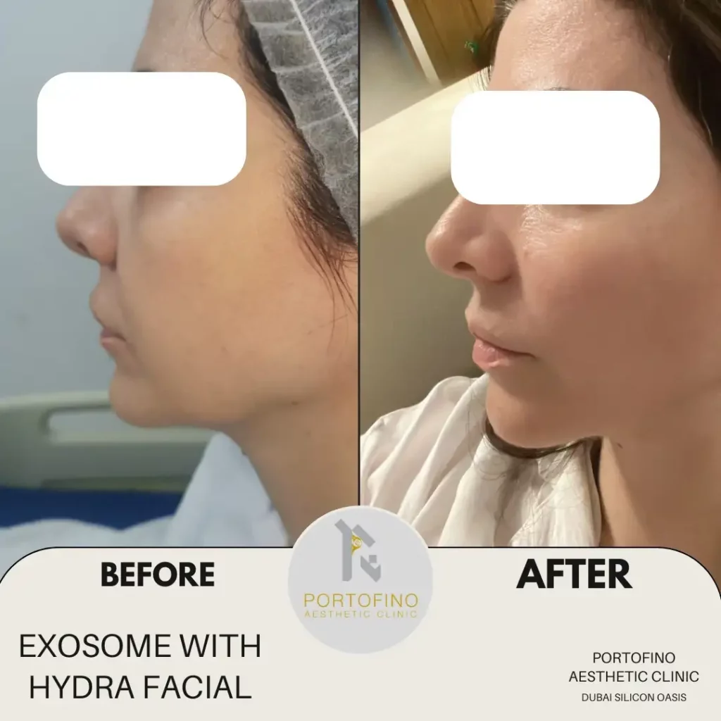 Exsome with Hydrafacial - Before and After