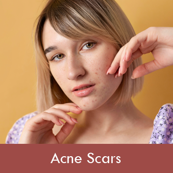 Acne Scar Removal Dubai