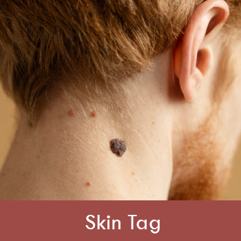 Skin Tag Removal Dubai