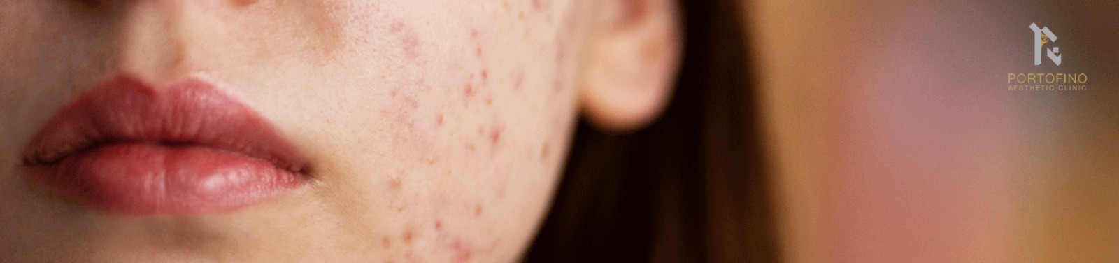 Acne Scars Removal Dubai