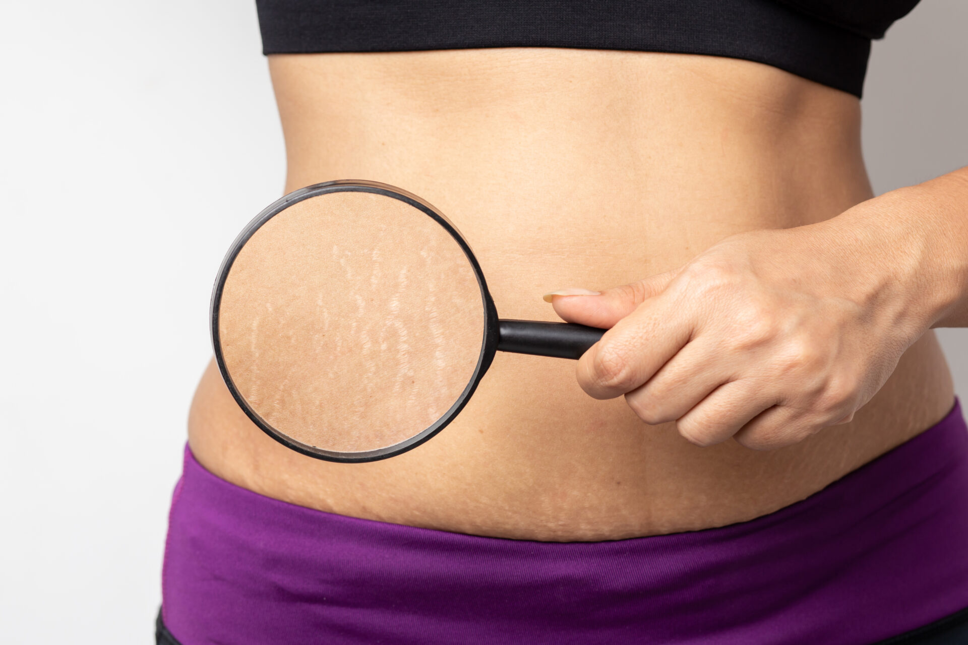 Laser Stretch Mark Removal Dubai | Best Laser Clinic Dubai