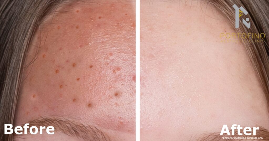 laser skin resurfacing