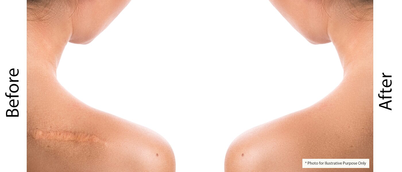 before after keoids before-after-keloid