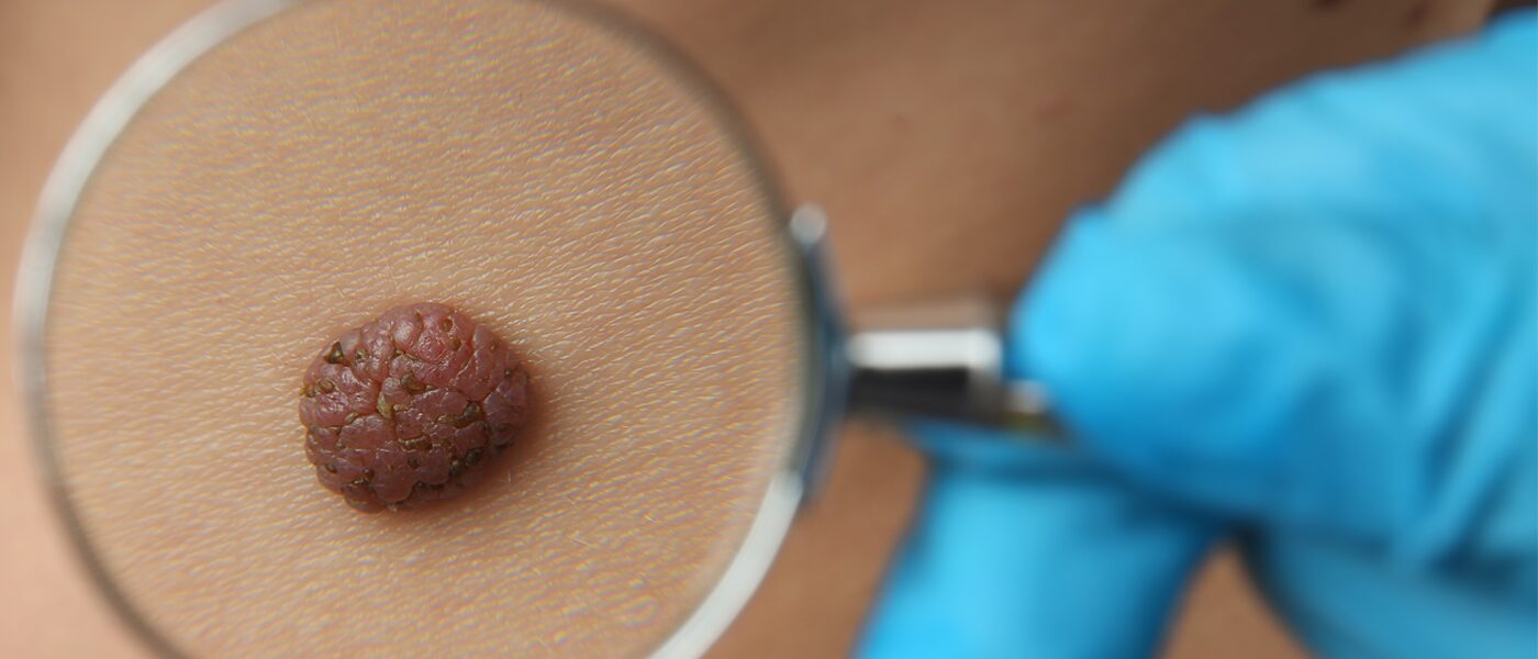 birth mark removal treatment birth-mark-removal-treatment