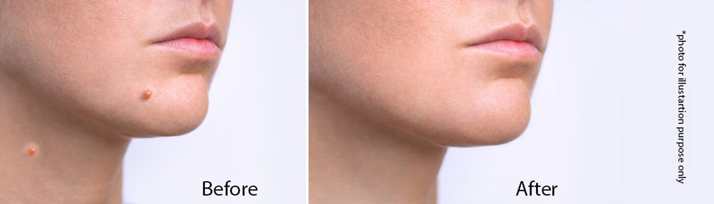 birthmark removal before and after 1 birthmark-removal-before-and-after