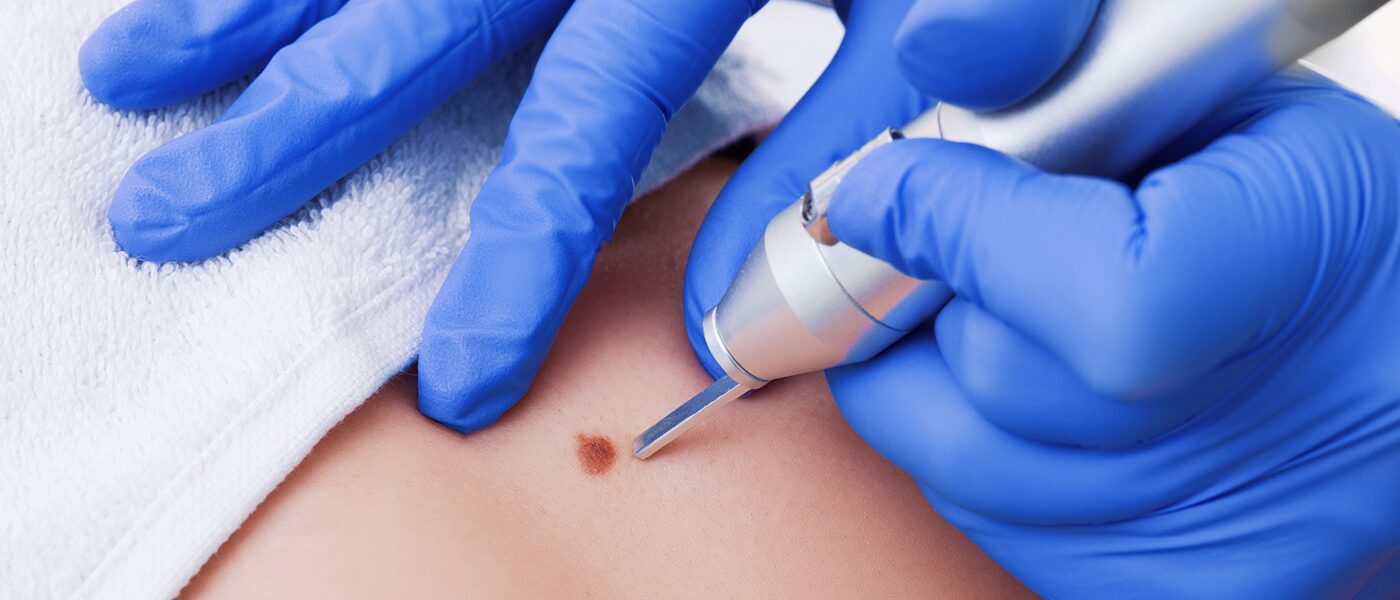mole removal before and after mole-removal-before-and-after