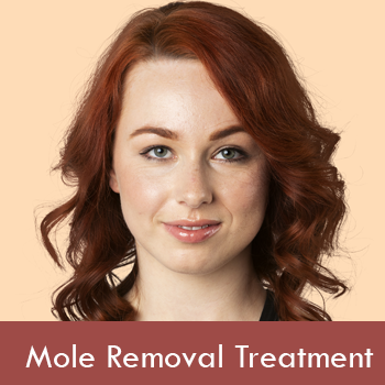 mole-removal-treatment