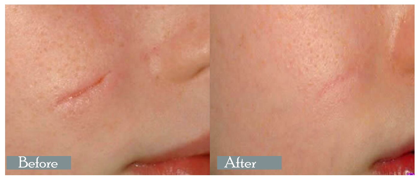 scar removal before After scar-removal-Before-&-After