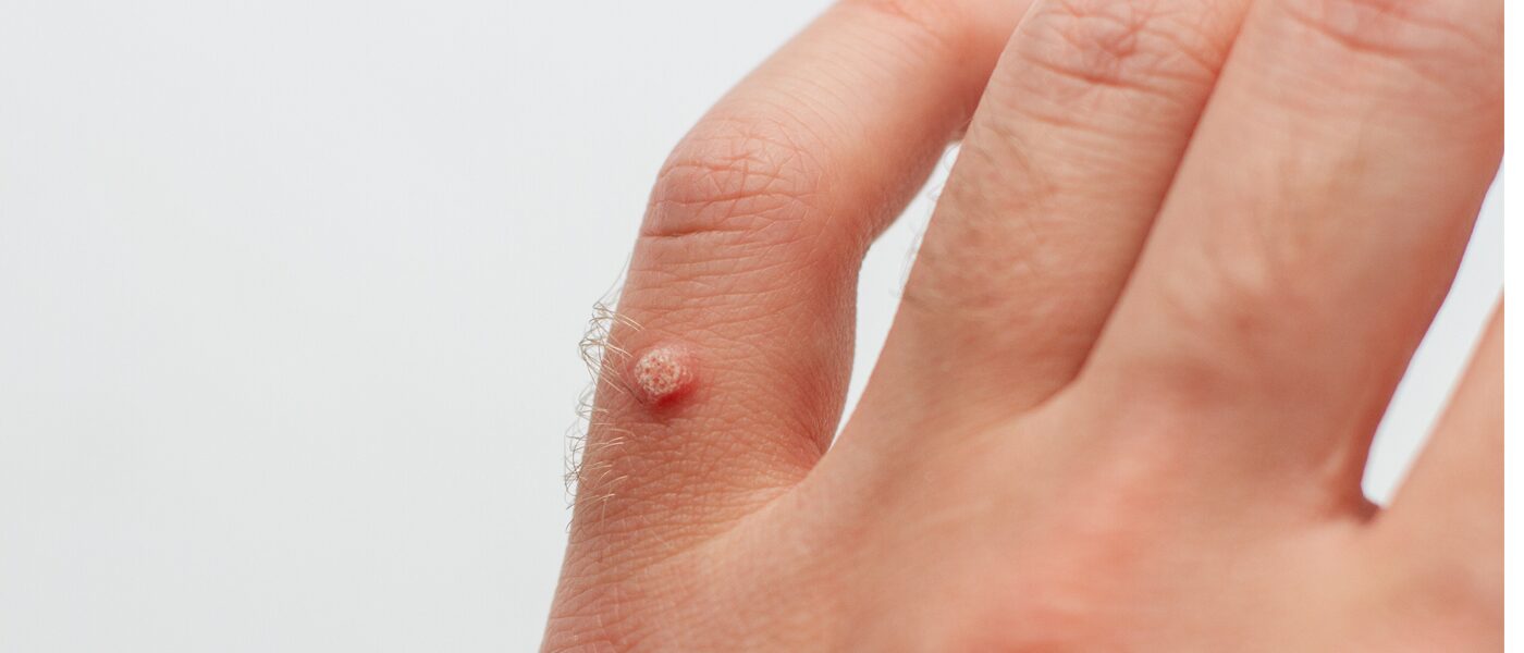 warts on hand warts-on-hand