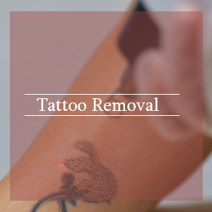 tattoo-removal