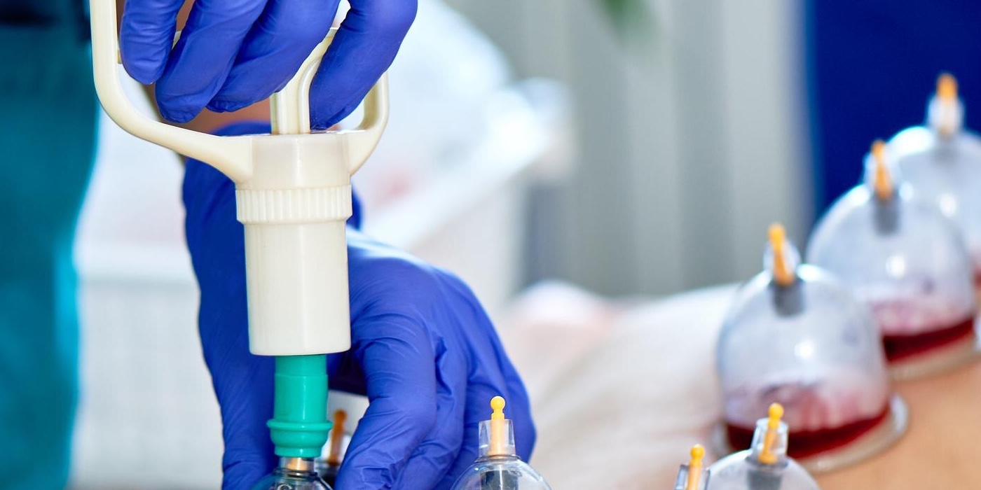 Hijama Cupping Near Me